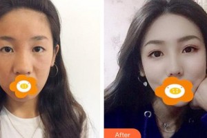 云南銅雀臺整形美容醫(yī)院周柯院長整形價格表附鼻部綜合案例展示