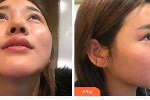云南銅雀臺整形美容醫(yī)院顏子云整形價格表附鼻部綜合案例展示