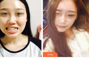 云南高原皮膚病醫(yī)院楊景平整形價格表附面部矯正案例展示