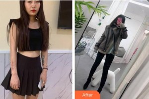 云南銅雀臺整形美容醫(yī)院鄧皓仁院長整形價格表附激光祛疤案例展示