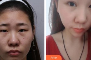 云南省第一人民醫(yī)院眼科李曉亮整形價格表附眼部綜合案例展示