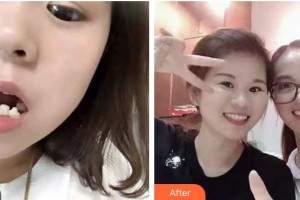 云南德普口腔醫(yī)院王霞整形價格表附牙齒陶瓷矯正案例展示