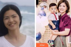 云南省第一人民醫(yī)院眼科汪潔整形價格表附牙齒隱形矯正案例展示