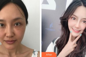 云南妤繡醫(yī)療美容診所王鳳整形價格表附彩光嫩膚案例展示