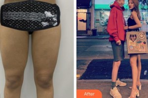 昆明吳氏嘉美美容醫(yī)院劉勤整形價格表附吸脂案例展示