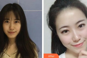 昆明吳氏嘉美美容醫(yī)院李韜整形價格表附無針水光案例展示