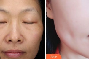 昆明愛萊美醫(yī)療美容醫(yī)院焦廣銀整形價格表附光子嫩膚案例展示