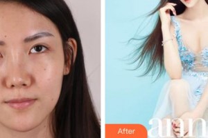 昆明都市儷人美容醫(yī)院金海坤整形價格表附墊鼻基底案例展示