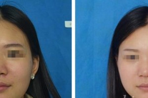 昆明麗都醫(yī)療美容醫(yī)院李光躍整形價格表附微針水光案例展示