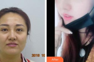 整形醫(yī)院劉小星整形價(jià)格表附鼻部綜合案例展示