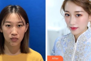 昆明楊穗醫(yī)療美容診所楊穗整形價(jià)格表附膨體隆鼻案例展示