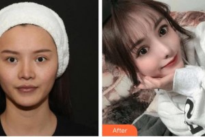 昆明都市儷人美容醫(yī)院楊麗璇整形價(jià)格表附鼻修復(fù)案例展示