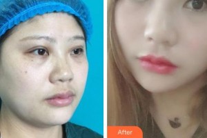 昆明吳氏嘉美美容醫(yī)院李允怡整形價(jià)格表附面部吸脂案例展示