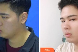 昆明醫(yī)學(xué)院第二附屬醫(yī)院燒傷整形科付晉鳳整形價(jià)格表附減脂案例展示