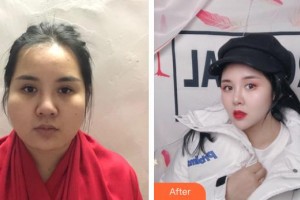 昆明赫柏醫(yī)療美容門診部劉傳君整形價(jià)格表附面部吸脂案例展示