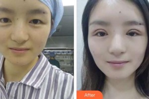 昆明超然醫(yī)學(xué)整形美容外科醫(yī)院李晉豫整形價(jià)格表附切開(kāi)雙眼皮案例展示