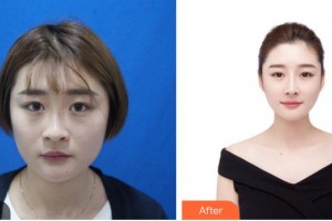 昆明吳氏嘉美美容醫(yī)院朱妮娜整形價(jià)格表附鼻修復(fù)案例展示