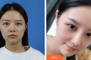 昆明天倫婦產醫(yī)院醫(yī)學整形美容中心蘭娜整形價格表附微針美膚案例展示