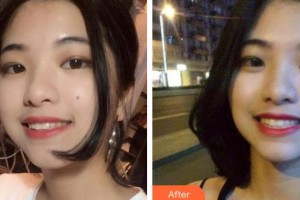 昆明前衛(wèi)美眼整形?？圃\所劉流整形價格表附牙齒隱形矯正案例展示