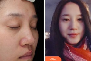 昆明都市儷人美容醫(yī)院李弘基整形價(jià)格表附祛斑祛痣案例展示