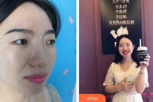 昆明維多利亞醫(yī)療美容醫(yī)院王興弘整形價格表附光子嫩膚案例展示