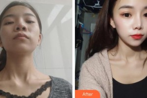 昆明愛(ài)萊美醫(yī)療美容醫(yī)院李元駿整形價(jià)格表附鼻部綜合案例展示