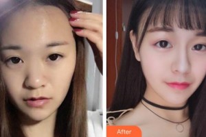 整形醫(yī)院陳茂年整形價(jià)格表附耳軟骨復(fù)合隆鼻案例展示