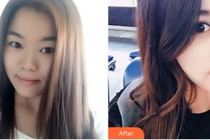 整形醫(yī)院尹海榮整形價(jià)格表附鼻部綜合案例展示