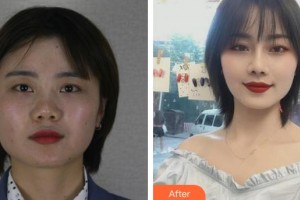 昆明同仁醫(yī)院醫(yī)療美容科劉波整形價(jià)格表附耳軟骨復(fù)合隆鼻案例展示