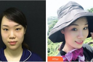 整形醫(yī)院周岳汗整形價(jià)格表附鼻部綜合案例展示