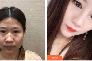 昆明韓辰整形醫(yī)院肖育亮整形價(jià)格表附鼻部綜合案例展示