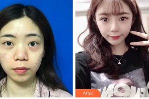 昆明維多利亞醫(yī)療美容醫(yī)院成昌燮整形價格表附鼻部綜合案例展示