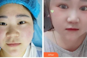 昆明赫柏醫(yī)療美容門診部金東杰整形價(jià)格表附開(kāi)內(nèi)眼角案例展示