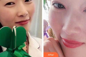 昆明韓辰整形醫(yī)院李相奇整形價(jià)格表附切開(kāi)雙眼皮案例展示