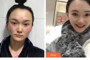 昆明維多利亞醫(yī)療美容醫(yī)院金浩彬整形價(jià)格表附顴骨顴弓整形術(shù)案例展示