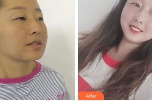 整形醫(yī)院董慧整形價(jià)格表附面部吸脂案例展示