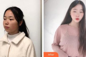 昆明市延安醫(yī)院杰西艾美容醫(yī)院王洋洋整形價(jià)格表附面部吸脂案例展示