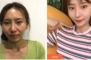 昆明愛(ài)萊美醫(yī)療美容醫(yī)院徐和林整形價(jià)格表附顴骨顴弓整形術(shù)案例展示