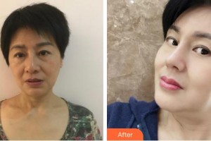 昆明美吉星醫(yī)療美容門(mén)診部陸磊整形價(jià)格表附膨體隆鼻案例展示