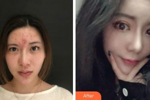 昆明都市儷人美容醫(yī)院李關(guān)文整形價(jià)格表附隆鼻案例展示