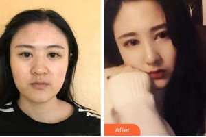 昆明夢(mèng)想醫(yī)療美容醫(yī)院李華整形價(jià)格表附耳軟骨復(fù)合隆鼻案例展示