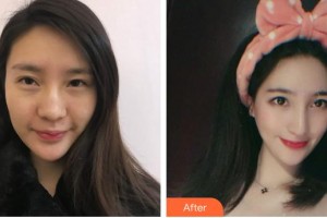 昆明夢(mèng)想醫(yī)療美容醫(yī)院趙正杰整形價(jià)格表附膨體隆鼻案例展示