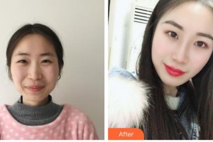 昆明薇莎整形美容醫(yī)院鄧麗麗整形價(jià)格表附鼻部綜合案例展示