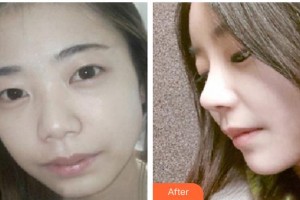 昆明都市儷人美容醫(yī)院孫燕整形價(jià)格表附鼻部綜合案例展示