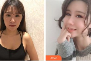 昆明薇莎整形美容醫(yī)院梁?jiǎn)⒋赫蝺r(jià)格表附肋軟骨隆鼻案例展示