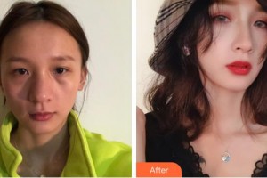 昆明薇莎整形美容醫(yī)院任德浩整形價(jià)格表附鼻部綜合案例展示