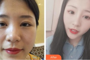 昆明赫柏醫(yī)療美容門診部楊軍叢整形價(jià)格表附鼻部綜合案例展示