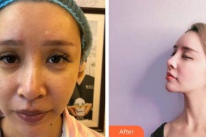 昆明美立方（原大華）醫(yī)療美容醫(yī)院高丹整形價(jià)格表附鼻修復(fù)案例展示