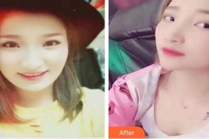 昆明美立方（原大華）醫(yī)療美容醫(yī)院鄭華山整形價(jià)格表附玻尿酸精華導(dǎo)入案例展示