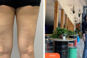 昆明愛萊美醫(yī)療美容醫(yī)院曾垂紳整形價(jià)格表附吸脂案例展示